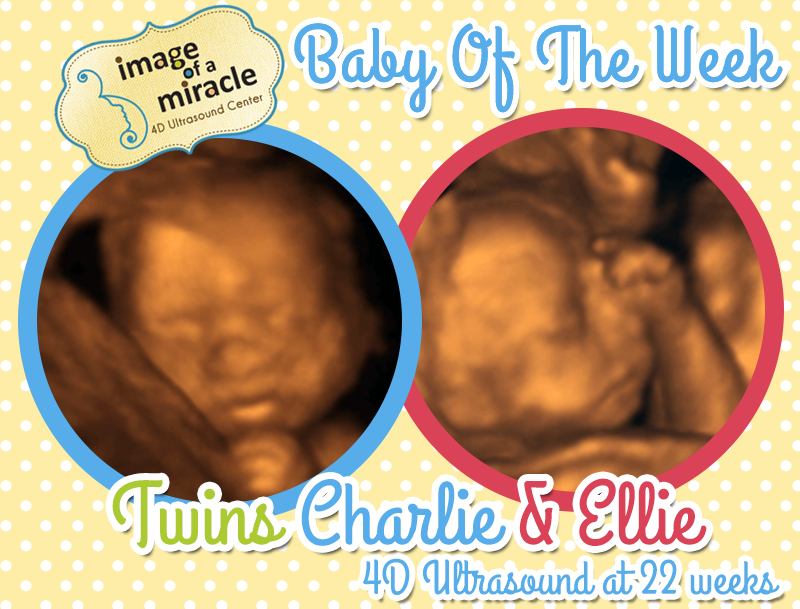 Baby of the Week Twins 4D Ultrasound
