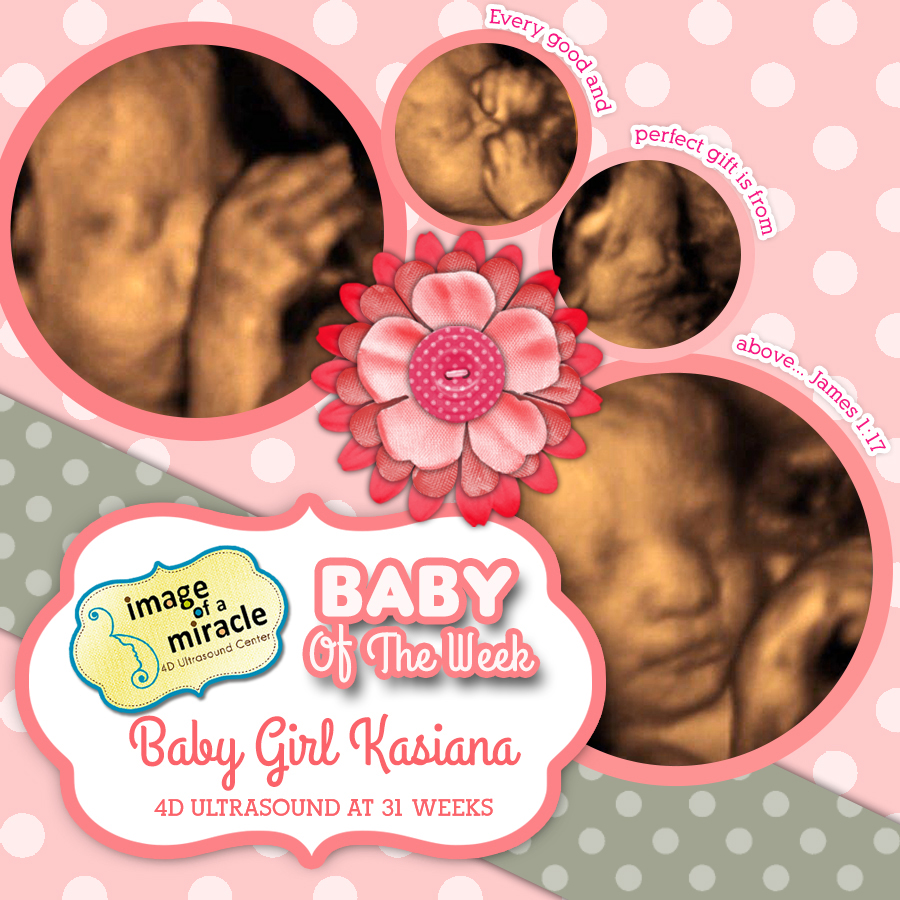 Our Baby of the Week is Baby Girl Kasiana! Her 4D Ultrasound was done at 31 weeks. We got several cute poses of her hands and face.