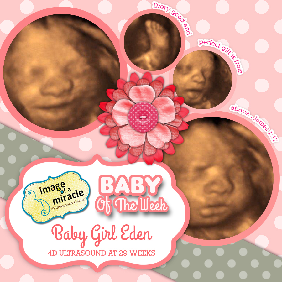 Our Baby of the Week is Baby Girl Eden! Her 4D Ultrasound was done at 29 weeks. We got several cute images of her face and smile.